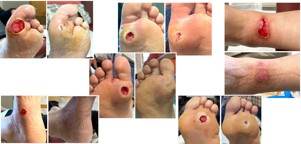 Collage of images showing wound healing progression with stunning before and after wound healing visuals showing the positive impact of using NATROX O2 topical oxygen therapy to help kickstart healing on chronic wounds