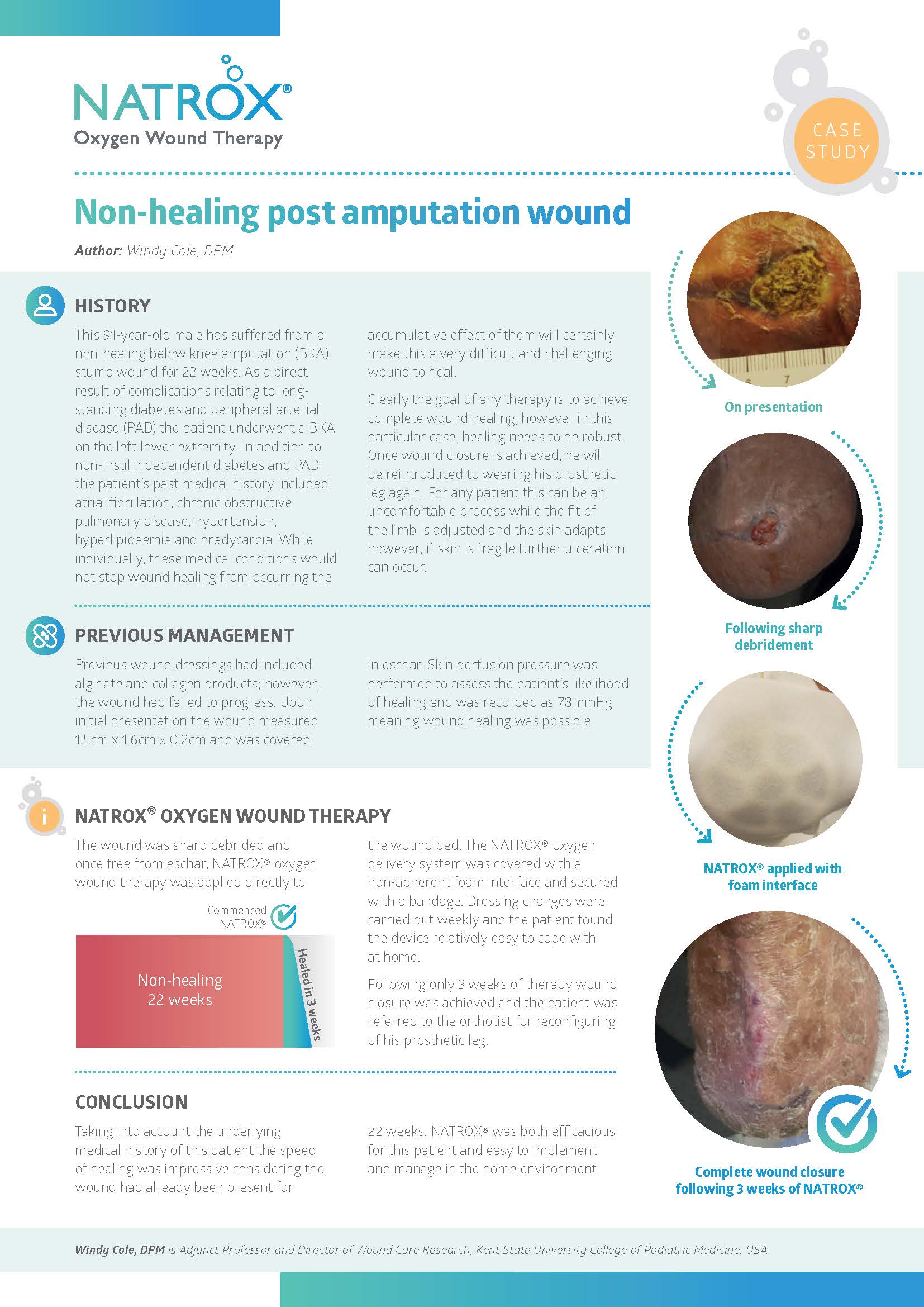 Non healing post amputation wound