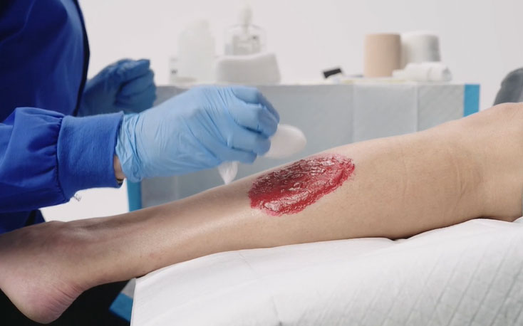 Preparing a wound for the application of the NATROX® O₂ device