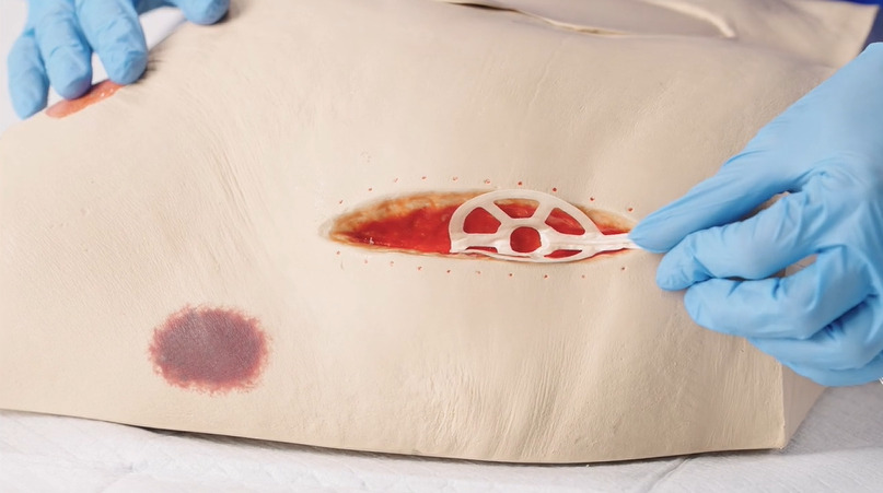 How to apply the NATROX® O₂ device for treating non-healing surgical wounds