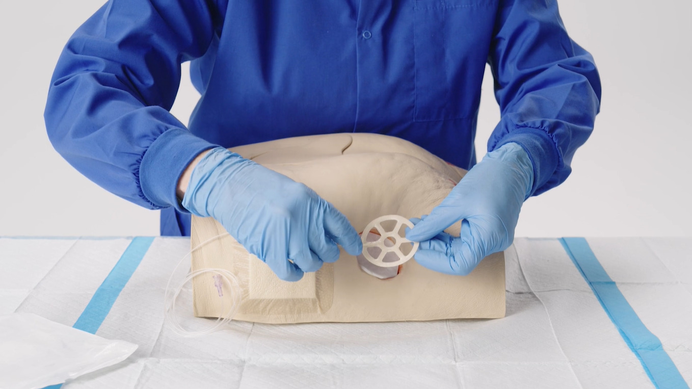 How to apply the NATROX® O₂ device for treating non-healing surgical wounds.