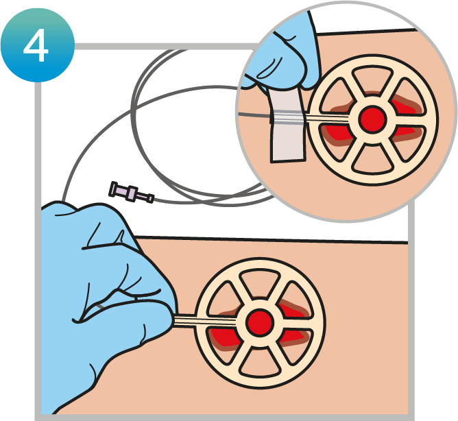 Apply directly to the wound bed. Remember to consider the positioning of the tubing for optimum patient comfort. You can position the tube in any direction and secure with tape, if necessary.