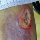 Initial presentation for therapy showing a chronic and difficult-to-heal wound
