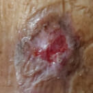 Reduced wound size and marked healing after 3 weeks of NATROX® O₂ topical oxygen therapy